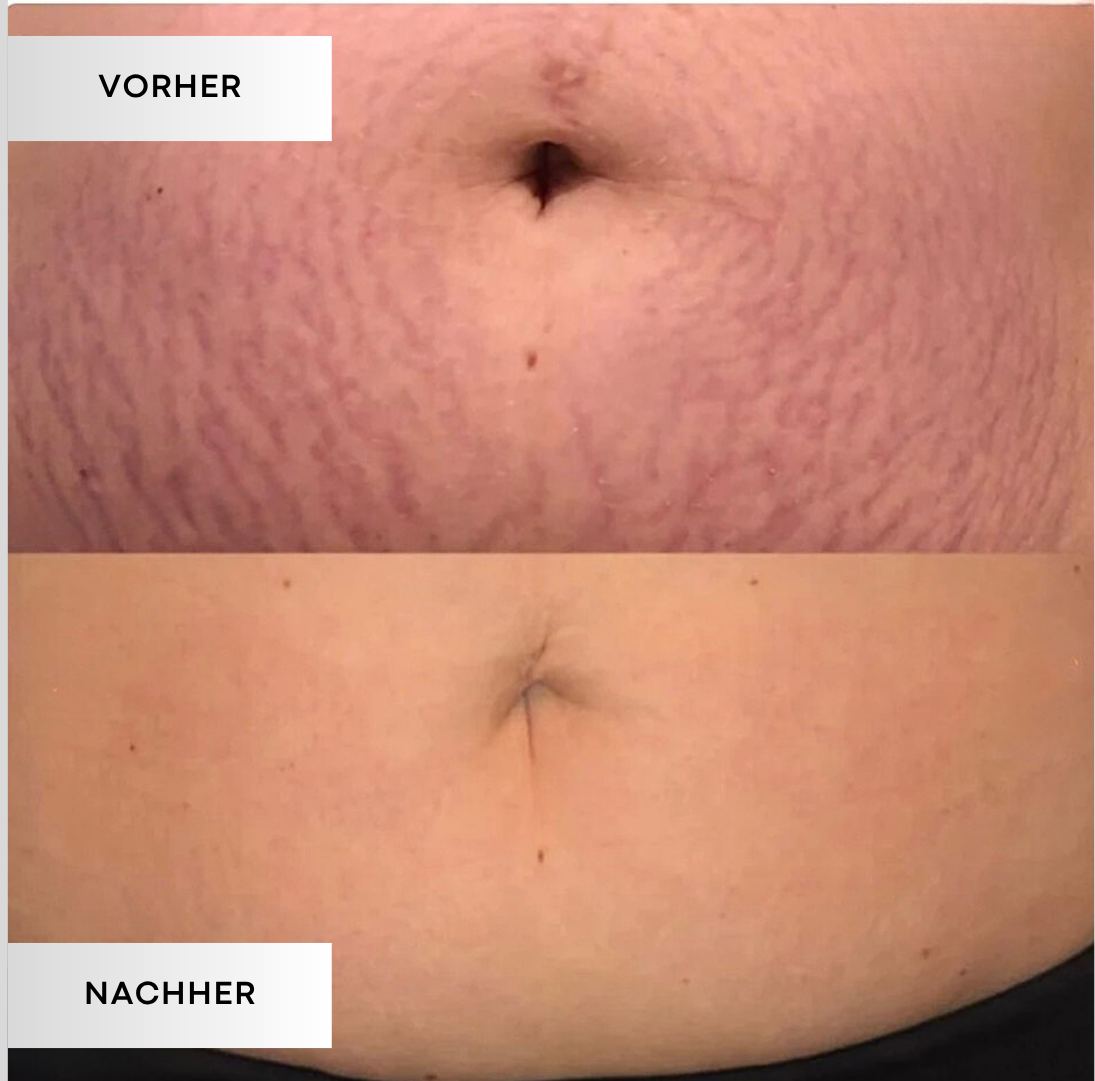 PureStretch - Dehnungsstreifen sanft mildern. Haut sichtbar glätten.