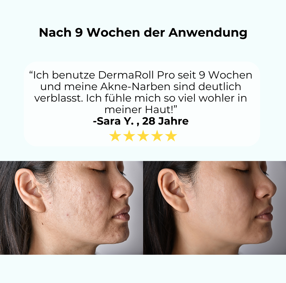 DermaRoll Pro™️ - Die Kunst der Mikronadeln