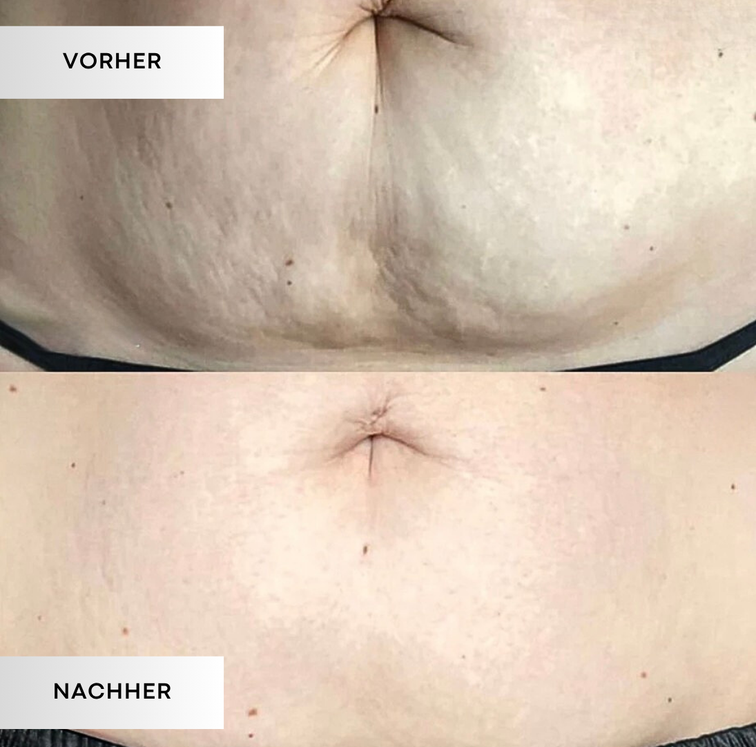 PureStretch - Dehnungsstreifen sanft mildern. Haut sichtbar glätten.
