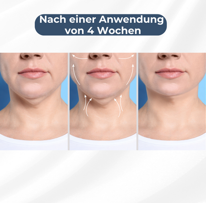 EMStone™️ – Die Revolution der Hautstraffung